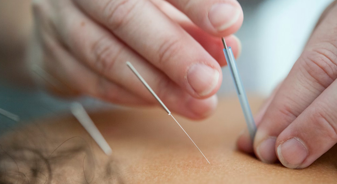 acupuncture alternative treatment for pain
